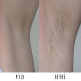 hair removal handpiece result